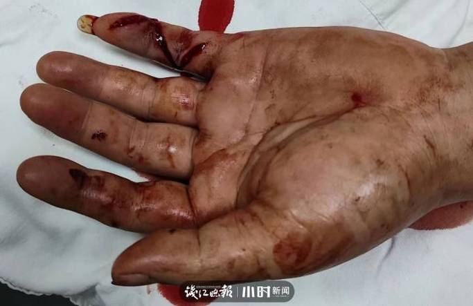 新澳最新版精准特和被蛇咬两年仍后遗症与被蛇咬了几年后身体有毒素吗